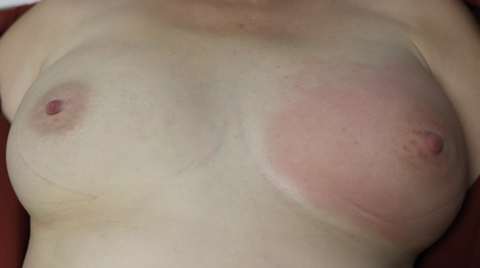 Mastitis at presentation